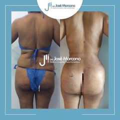 Liposucción - Dr. Jose Alejandro Marcano Delgado