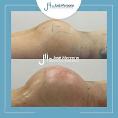 Gluteoplastia - Dr. Jose Alejandro Marcano Delgado