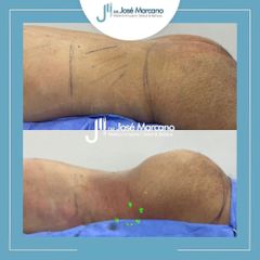 Gluteoplastia - Dr. Jose Alejandro Marcano Delgado