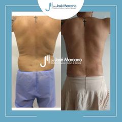 Liposucción - Dr. Jose Alejandro Marcano Delgado