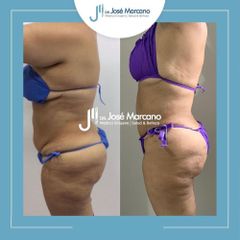 Liposucción - Dr. Jose Alejandro Marcano Delgado