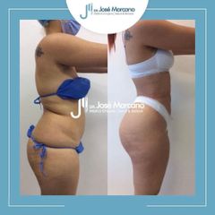 Liposucción - Dr. Jose Alejandro Marcano Delgado