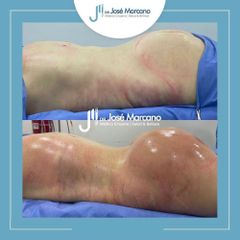 Gluteoplastia - Dr. Jose Alejandro Marcano Delgado
