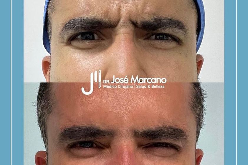 Bótox antes y después - 799472