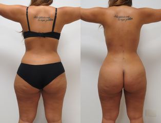 Liposucción - Dra. Jenny Diaz Cortés