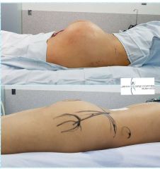 Gluteoplastia - Dra. Jenny Diaz Cortés