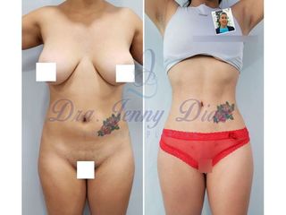 Liposucción - Dra. Jenny Diaz Cortés