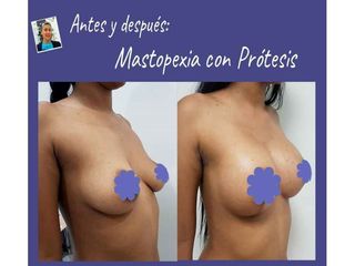 Mamoplastia de aumento - Dra. Jenny Diaz Cortés