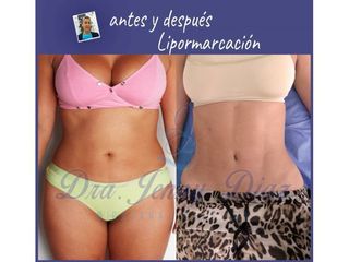 Lipoescultura - Dra. Jenny Diaz Cortés