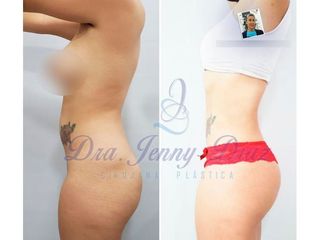 Liposucción - Dra. Jenny Diaz Cortés