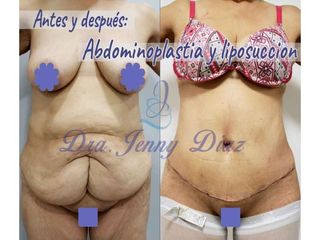 Abdominoplastia - Dra. Jenny Diaz Cortés