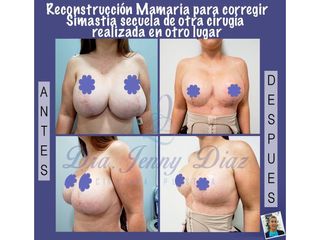 Mamoplastia de reducción - Dra. Jenny Diaz Cortés