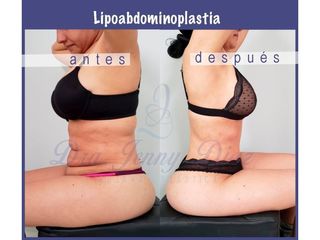 Abdominoplastia - Dra. Jenny Diaz Cortés