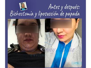 Bichectomía - Dra. Jenny Diaz Cortés