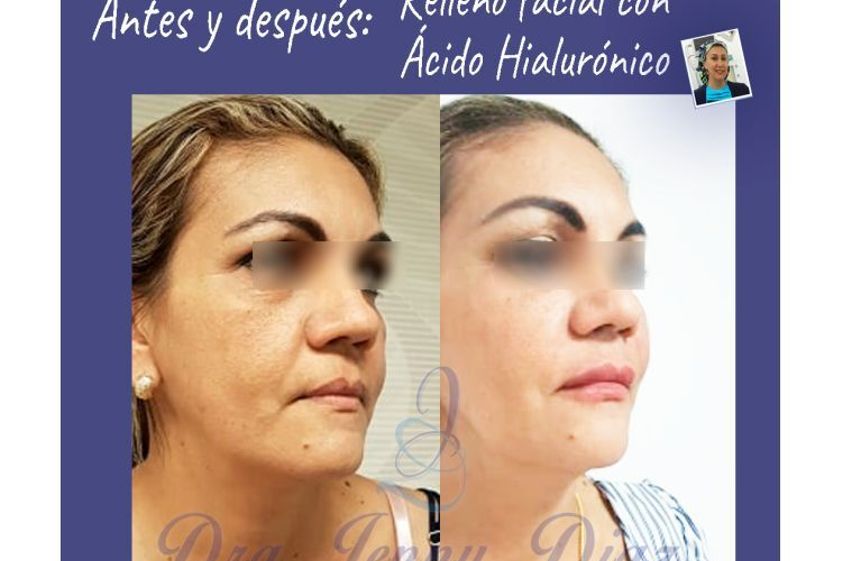 Ácido hialurónico antes y después - 739268