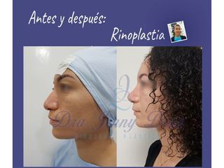 Rinoplastia - Dra. Jenny Diaz Cortés