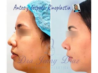 Rinoplastia - Dra. Jenny Diaz Cortés