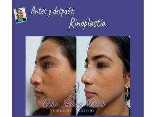 Rinoplastia - Dra. Jenny Diaz Cortés