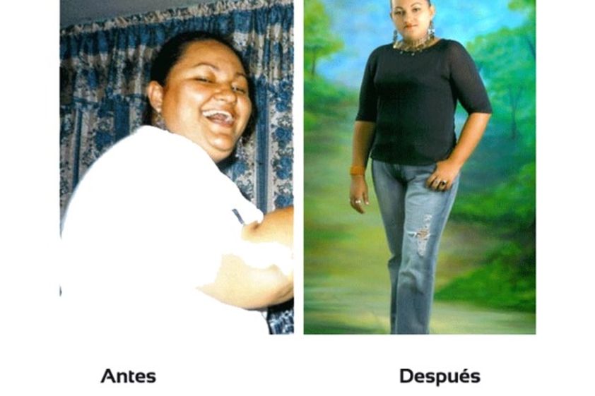 Bypass Gástrico antes y después - 509870