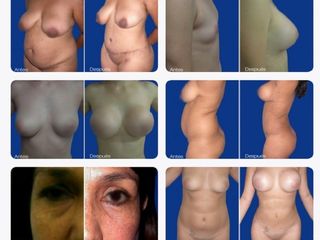 Antes - despues