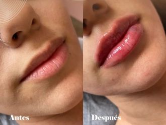 Aumento de labios - 862308