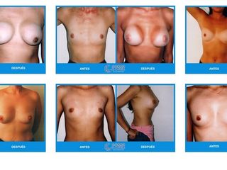 Mamoplastia