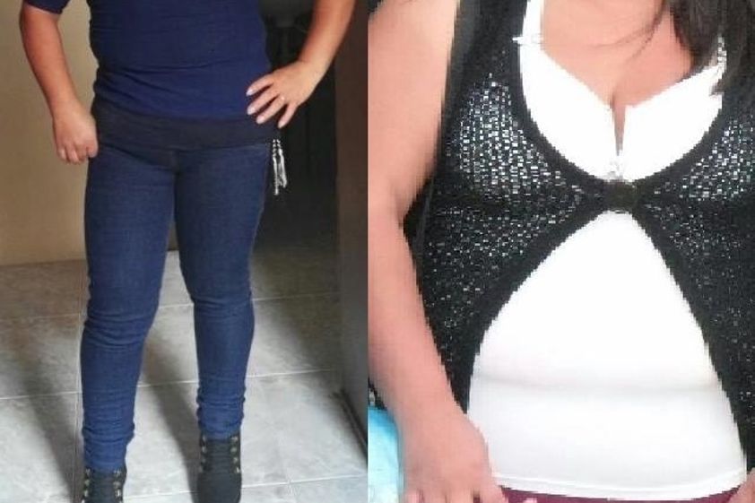 Bypass Gástrico antes y después - 741870