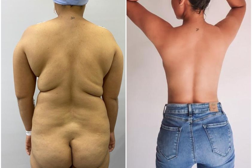Liposucción antes y después - 820368