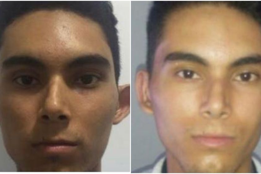 Otoplastia antes y después - 820447