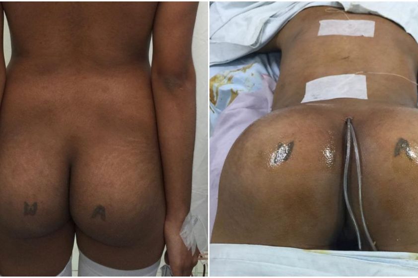 Gluteoplastia antes y después - 820460