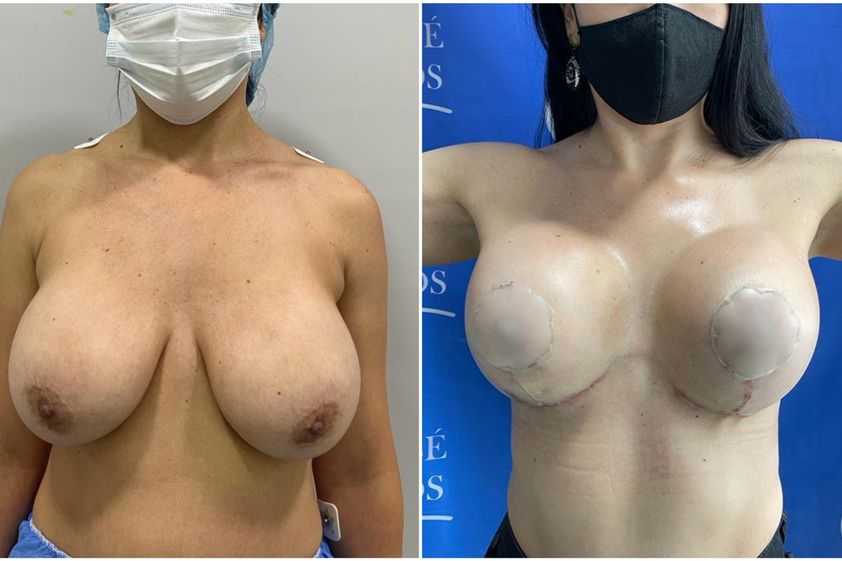 Mamoplastia de reducción antes y después - 820463