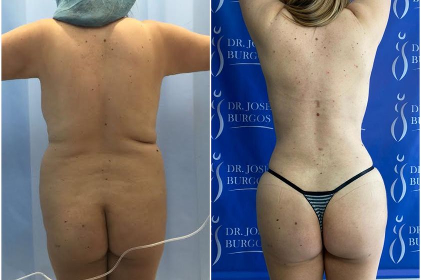 Liposucción antes y después - 820465