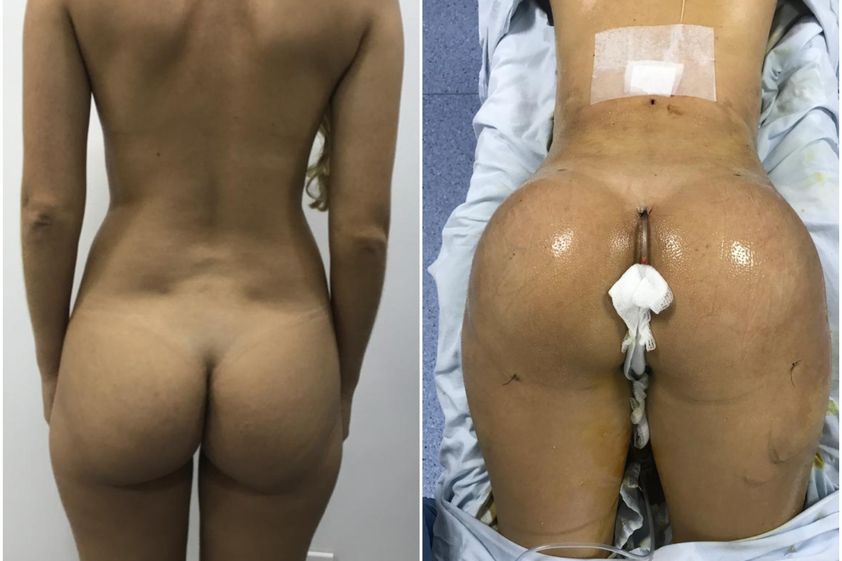 Gluteoplastia antes y después - 820466