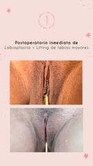 Labioplastia - Dra. Vanessa López Ramírez