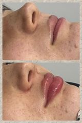 Aumento de labios - Dra. Manuela Gómez Londoño
