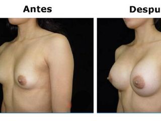 Mamoplastia