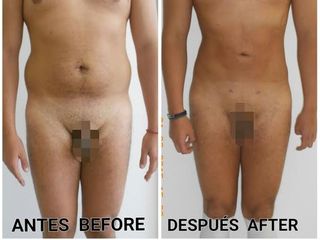 Abdominoplastia