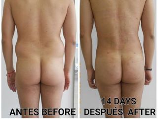 Abdominoplastia