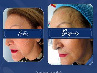 Bótox antes y después - 880424