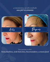 Botox, Ácido Hialurónico, Bioestimuladores y Armonia facial