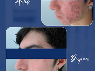Acné antes y después - 880426