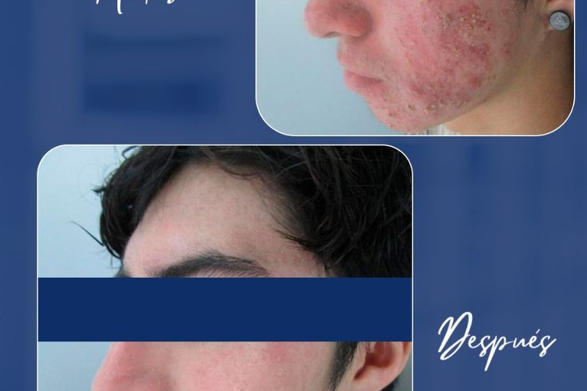 Acné antes y después - 880426