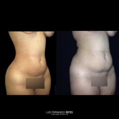 Lipoescultura