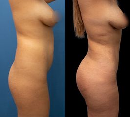 Liposucción - Dr. Luis Fernando Reyes