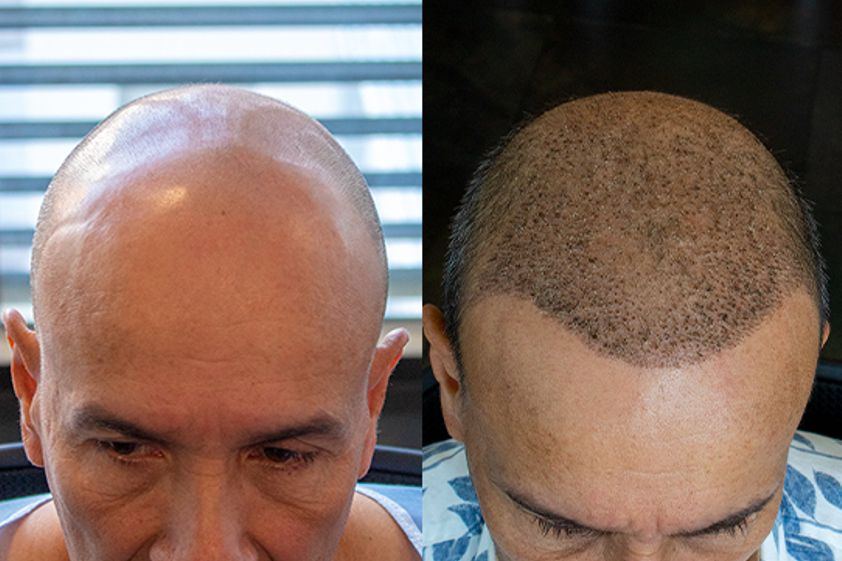 Trasplantes capilares antes y después - 699182