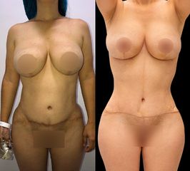 Abdominoplastia+pexiamamaria - Dr. Luis Fernando Reyes