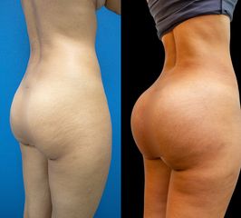 Gluteoplastia - Dr. Luis Fernando Reyes