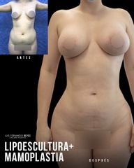 Lipoescultura - Dr. Luis Fernando Reyes