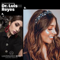 Rejuvenecimiento facial - Dr. Luis Fernando Reyes