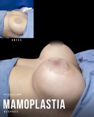 Mamoplastia de aumento - Dr. Luis Fernando Reyes
